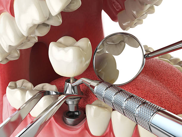 Best Emergency Tooth Extraction in Rutland, VT